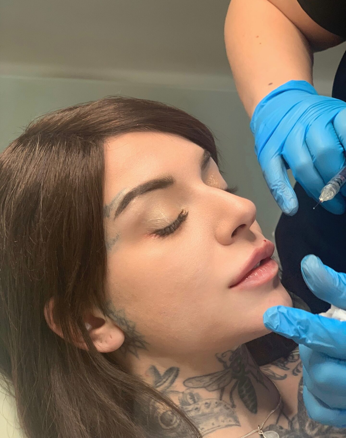 A picture of @evesaraeden getting her lip injections. 