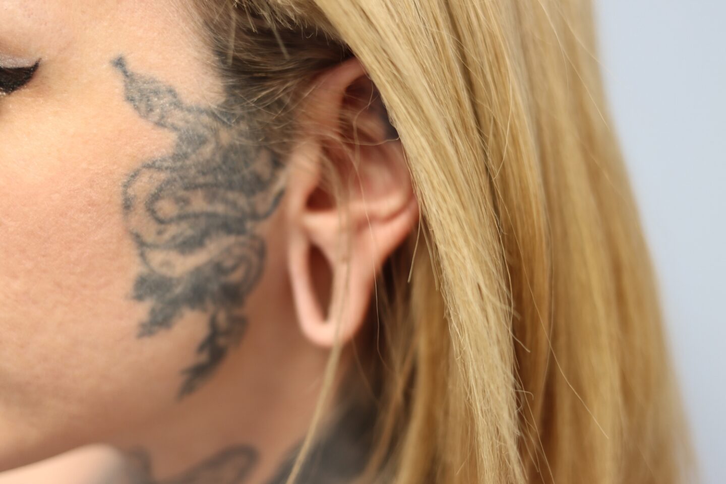 A picture of Eve Sara's ear before the surgery at Cosmedicare.