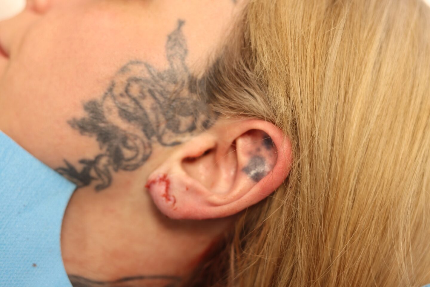A picture of Eve Sara's ear after the surgery at Cosmedicare.