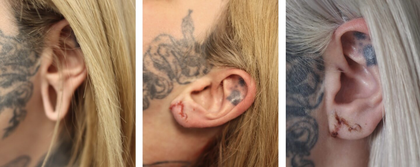 A picture of the process of Eve Sara's ear surgery.